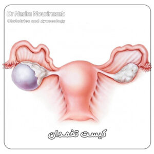 کیست تخمدان - دکتر نسیم نوری نسب