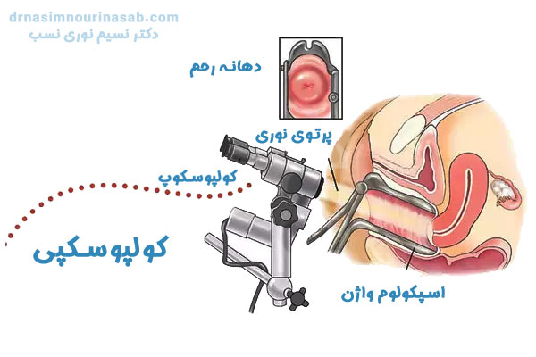 کولپوسکپی در کرمان - دکتر نسیم نوری نسب