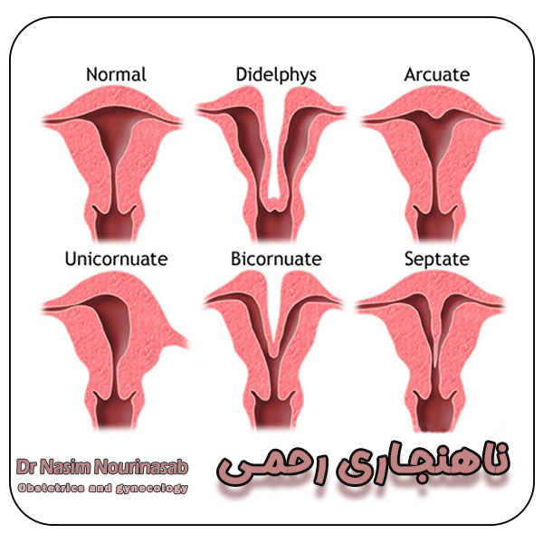 ناهنجاری های رحمی - دکتر نسیم نوری نسب