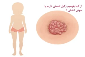 از کجا بفهمیم زگیل تناسلی داریم یا جوش