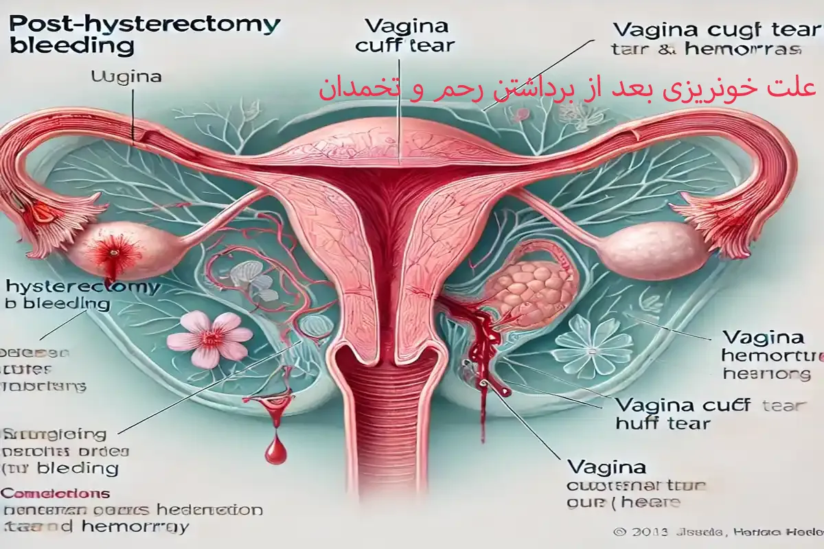 علت خونریزی بعد از برداشتن رحم و تخمدان