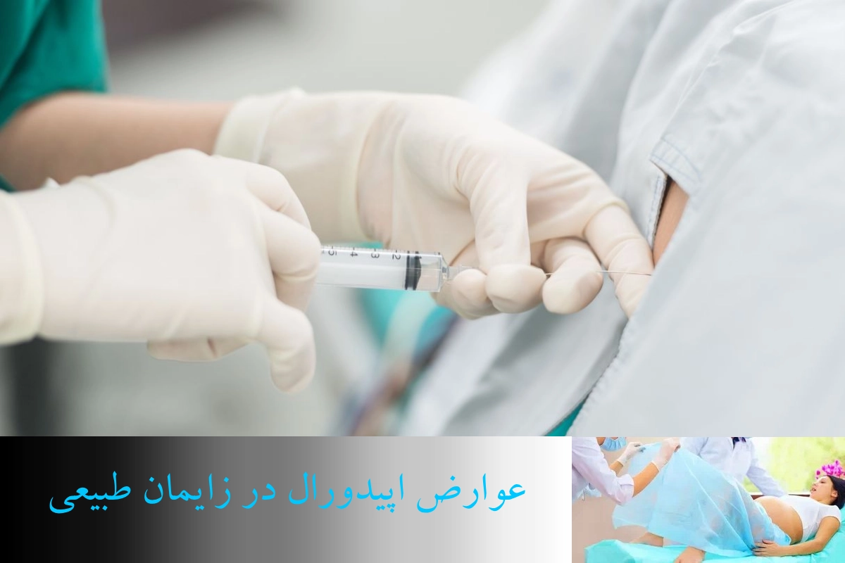 عوارض اپیدورال در زایمان طبیعی