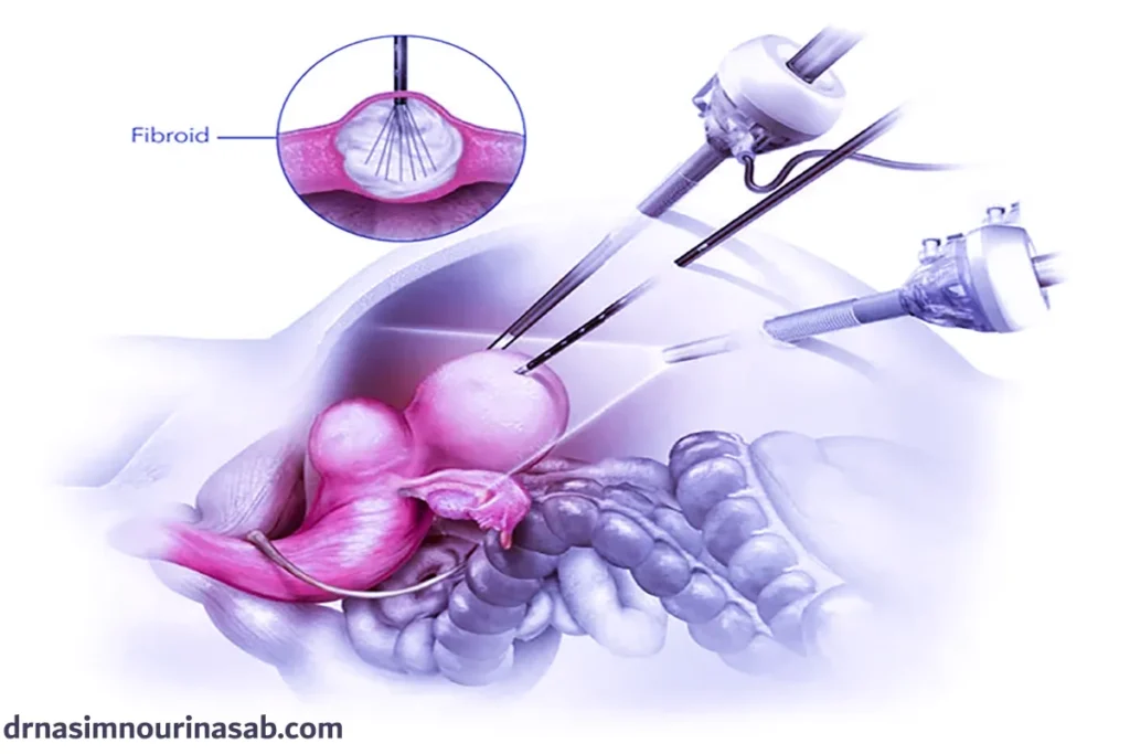 روش درمان فیبروم رحم